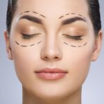 blefaroplastia (1)