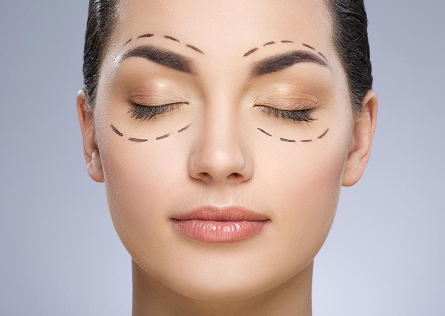 blefaroplastia (1)