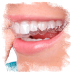 orofaciall-tratamentos-invisalign