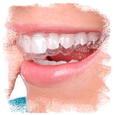 orofaciall-tratamentos-invisalign