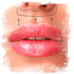 orofaciall-tratamentos-lip-lift