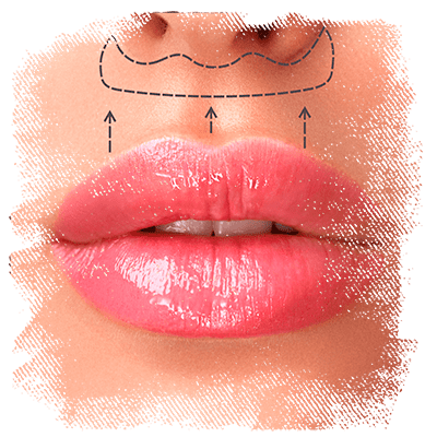 orofaciall-tratamentos-lip-lift