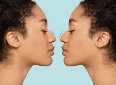 woman-getting-ready-for-nose-job-surgery (1)